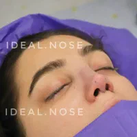 جراحی بینی با شرایط اقساطی