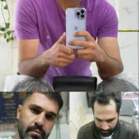 کاشت مو و ابرو در تبریز  اقساطی با اقامت رایگان