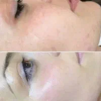 آموزش فیشیال تخصصی. مزو جوانساز صورت|خدمات آموزشی|کوهدشت, |دیوار