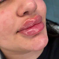 تزریق ژل و بوتاکس