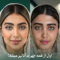 آف۷۰٪بوتاکس مزو ژل لب لیفت غبغب بینی ابرو فیلربادی