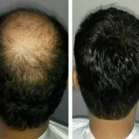 رویش مجدد مو تضمینی و قسطی|آرایشی، بهداشتی، درمانی|رشت, بلوار گیلان|دیوار