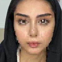 بوتاکس خطوط پیشانی و اخم رایگان‌ شد|خدمات آرایشگری و زیبایی|قم, هفت تیر|دیوار