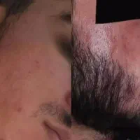 رشد ریش. اعتماد به نفس بیشتر.