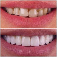 نیاز به مدل جهت زیبایی دندانهای قدامی (طرح لبخند)