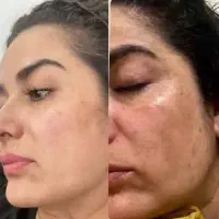 پوست پرتغالی پوست تیره پوست منافذ باز با یک کرم