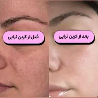 روشن و شفاف شدن پوست و‌حذف تتوبا لیزر کیوسوئیچ