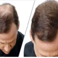 پک ریزش مو و رویش مجدد مو تضمینی