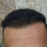 کاشت مو،ابرو،ریش وسیبیل،مزوتراپی وپی آرپی