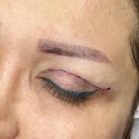 بلفاروپلاستی/ جراحی پلک فقط ۳م تخفیف ویژه