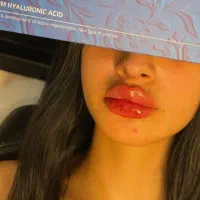 آف یلدایی ژل و بوتاکس