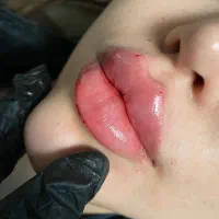 بوتاکس مصپورت ۳ناحیه ۸۹۰