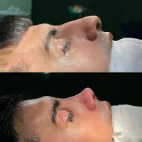 جشنوار تخفیفی ویژه عمل بینی