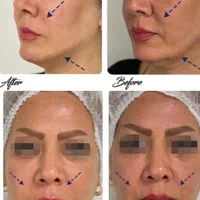 جشنواره هایفوتراپی vip همراه فیشال اشانتیون