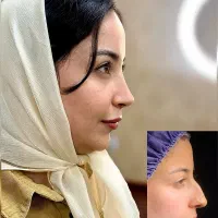 جراحی بینی با تخفیف باورنکردنی 50درصد|خدمات آرایشگری و زیبایی|قرچک, شهرک طلائیه|دیوار