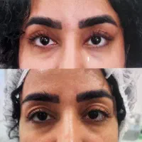 جشنواره تخفیفاتی بلفاروپلاستی با نقاهت ۲۴ ساعته