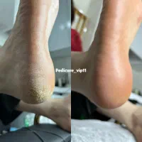 پدیکور درمان کف پاکفسابی/درمان کف پاباماساژ رایگان