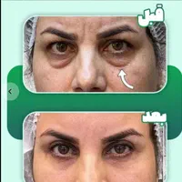 بلفارو پلاستی بالا و پایین|خدمات آرایشگری و زیبایی|تهران, شهران جنوبی|دیوار