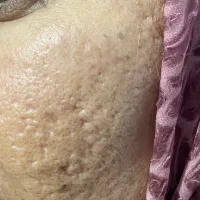 لیزرجای جوش ومنافذ دکتربهنام روایی