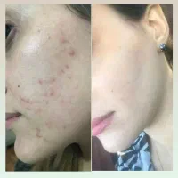 کرم بیو‌ ممتیک جوش