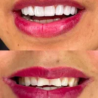 کامپوزیت ونیر و بلیچینگ (سفید کردن) دندان|خدمات آرایشگری و زیبایی|تاکستان, |دیوار