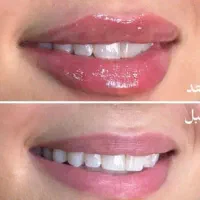 مدل ژل/فیلر لب|خدمات آرایشگری و زیبایی|تهران, قلهک|دیوار