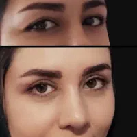 بلفاروپلاستی رفع پلک مدل بخیه لیزری/سانترال/بوکال|خدمات آرایشگری و زیبایی|تهران, هفت حوض|دیوار