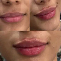 تخفیف ژل و بوتاکس