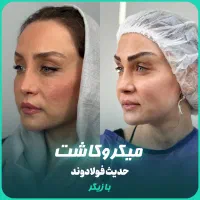 ابرو با متد میکرو کاشت مهرزاد