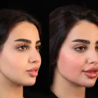 جشنواره تخفیف ژل بوتاکس مزو به مدت کوتاه درکلینیک