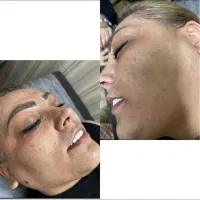 رفع لک و تیرگی صورت و بدن|آرایشی، بهداشتی، درمانی|پاکدشت, پاکدشت (مامازند)|دیوار