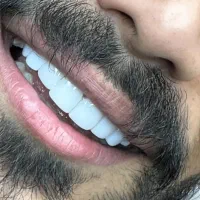کامپوزیت زیبایی اردبیل (حداقل تراش+شرایط اقساطی)