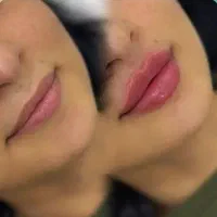 تزریق  ژل و بوتاکس تخفیف ویژه