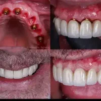اقساط 12 ماهه دندانپزشکی ایمپلنت عصب کشی وترمیم..