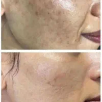 پاک کردن تتو با پیشرفته ترین لیزر کیوسوئیچ|خدمات آرایشگری و زیبایی|اهواز, کوی سعدی|دیوار