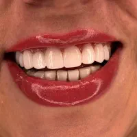 دندانپزشکی روکش  دیجیتال و کامپوزیت