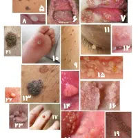 زگیل / تبخال تناسلی HPV / HSV