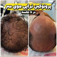 آف ۳۰% ژل بوتاکس بایوفیلر پی ارپی لاغری هایفو لیزر|خدمات آرایشگری و زیبایی|اهواز, کوی باهنر|دیوار