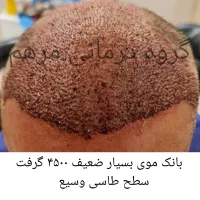 جشنواره کاشت مو در قم|خدمات آرایشگری و زیبایی|قم, میرزائیه|دیوار