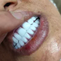 دندان مصنوعی طرح کامپوزیت و لمینت هر فک ۵ تومان|خدمات آرایشگری و زیبایی|کرج, کمالشهر|دیوار