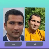 کاشت مو با بالا ترین تراکم و نازلترین قیمت|خدمات آرایشگری و زیبایی|تبریز, |دیوار