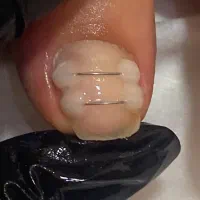 خدمات ارتونیل (ارتودنسی ناخن) و کف سابی درمانی