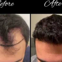 کاشت مو به روش میکرو گرافت Fit