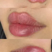 فیلر چانه گونه کانتورینگ زاویه ژل لب بوتاکس شیدینگ