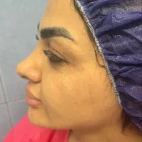 جراحی بینی متخصص جراح فک صورت ۴۵میلیون|خدمات زیبایی و سلامت|تهران, صاحبقرانیه|دیوار
