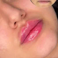 تزریق تخصصی فیلر، بوتاکس و جوانسازی ،فرم طبیعی