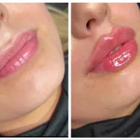 جشنواره تزریق ژل و بوتاکس (توسط پزشک)