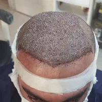 کاشت مو ابرو ساری با تراکم بالا