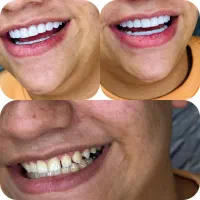 کامپوزیت دندان