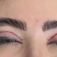 بلفاروپلاستی